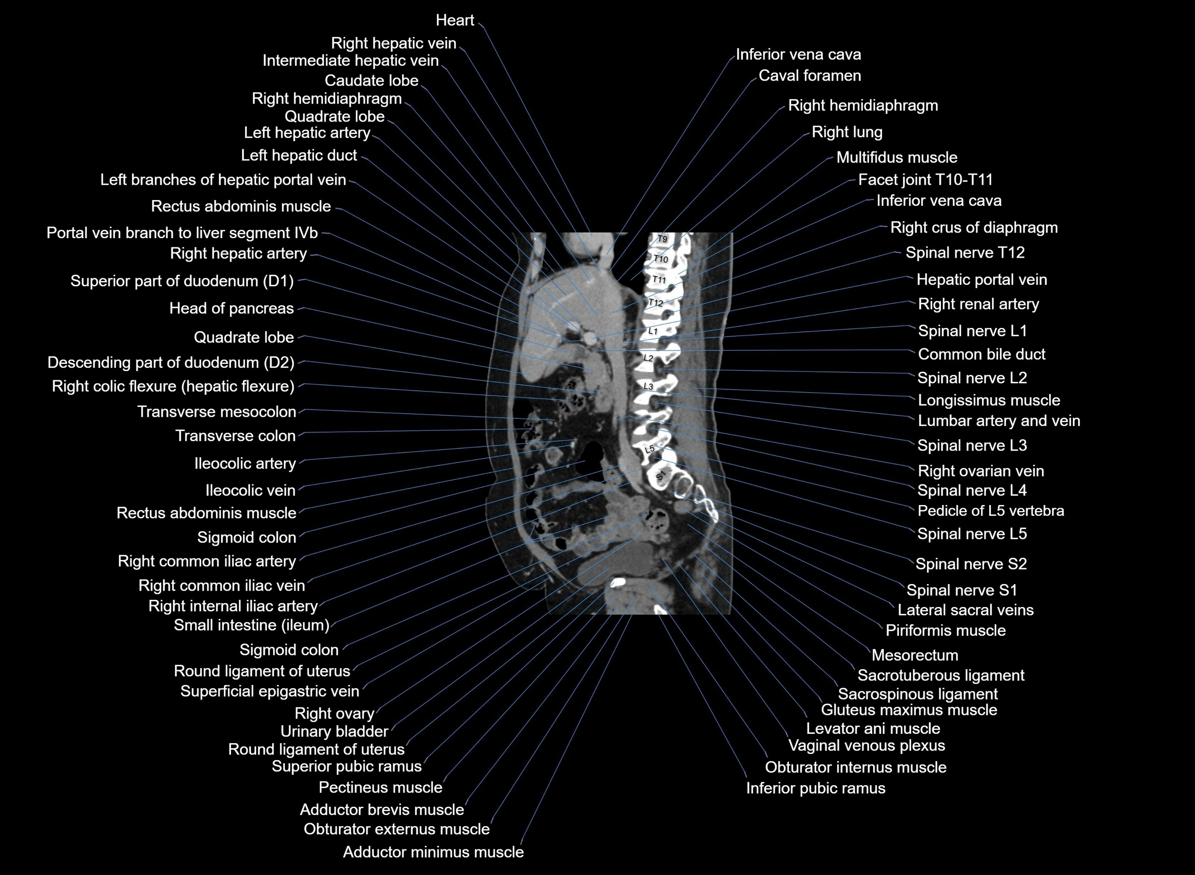 CT Abdomen sagittal cross sectional anatomy labelled radiology image -00068.webp